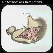toverlantaarnplaat drankbestrijding maag stomach drinker